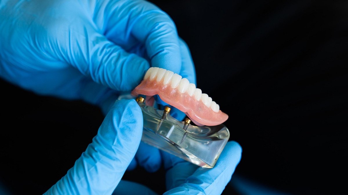 Prothèse sur implant