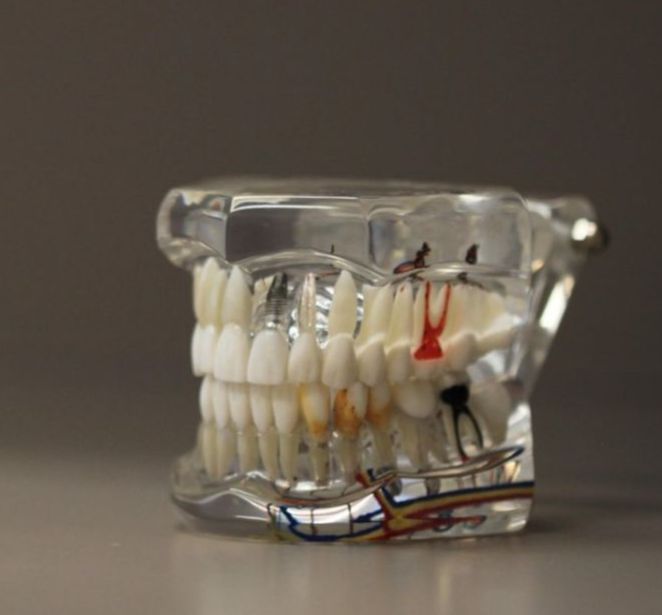 Modèle en plâtre préparé au laboratoire